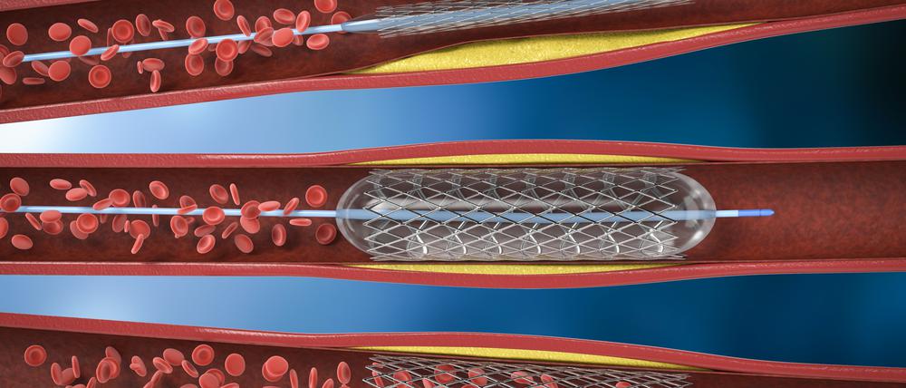 Bildliche Darstellung eines sogenannten Stents.
