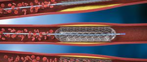 Bildliche Darstellung eines sogenannten Stents.