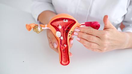 Endometriose wird jährlich in Deutschland bei rund 40.000 Frauen diagnostiziert.