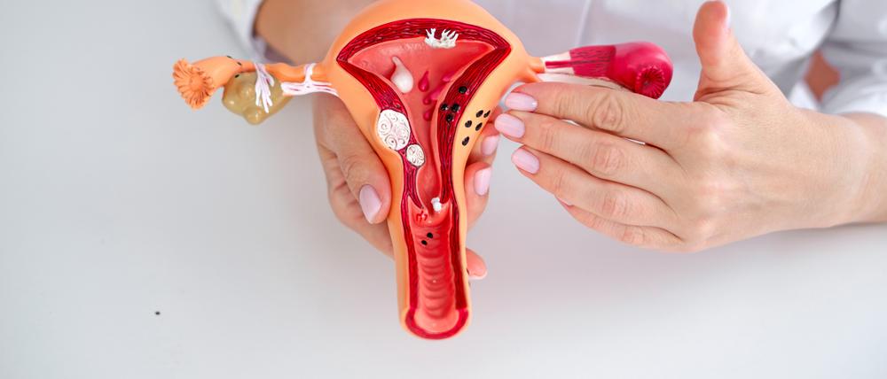 Endometriose wird jährlich in Deutschland bei rund 40.000 Frauen diagnostiziert.