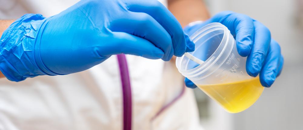 Urinproben zu nehmen, gehört zum täglichen Geschäft in einer Arztpraxis. (Symbolbild)
