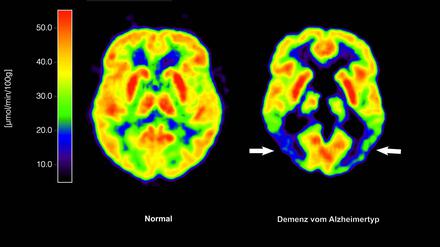Lecanemab richtet sich gegen Amyloid-Ablagerungen im Gehirn und soll dadurch den Verlauf der Krankheit ein wenig verlangsamen. (Archivbild)