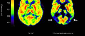 Lecanemab richtet sich gegen Amyloid-Ablagerungen im Gehirn und soll dadurch den Verlauf der Krankheit ein wenig verlangsamen. (Archivbild)