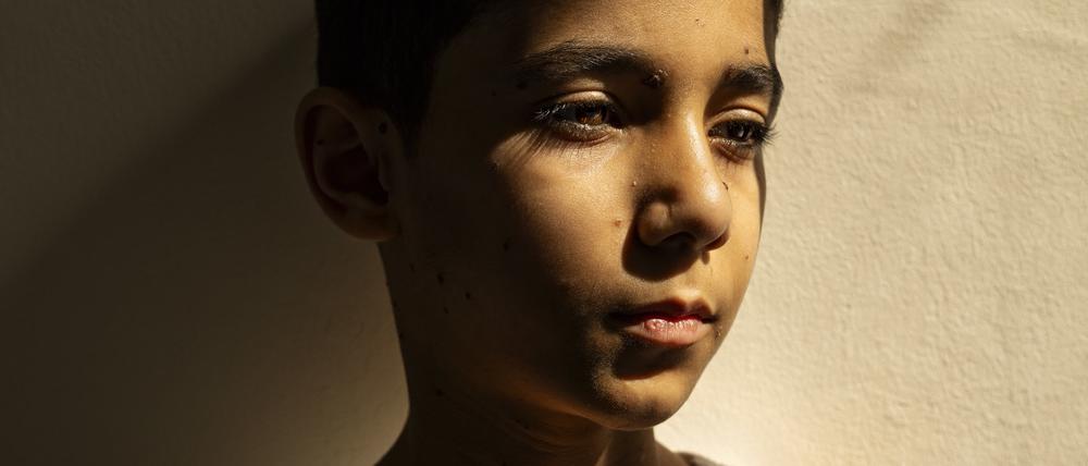 Dieses von „World Press Photo“ herausgegebene Foto zeigt Mahmoud Ajjour (9), der während des Gaza-Kriegs von einer Rakete eines israelischen Kampfflugzeugs getroffen wurde und beide Arme verlor.