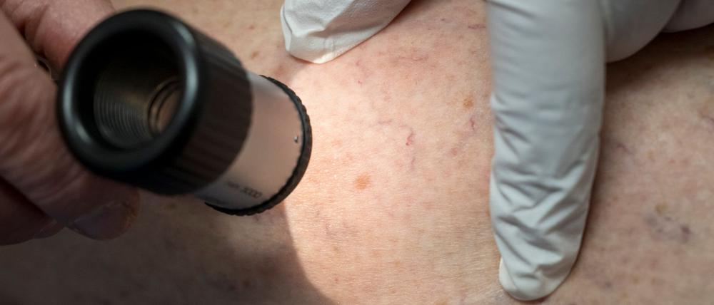 Die Zahl der Krankenhausbehandlungen von Hautkrebs stieg enorm an. (Symbolbild)