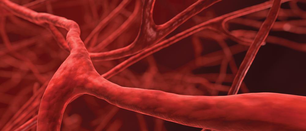 Rund zwei Prozent aller Männer zwischen 65 und 75 sind von einem Bauchaortenaneurysma betroffen.
