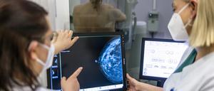 Die Mammographie kann acht von 1000 Frauen nachweislich vor einem Tod an Brustkrebs bewahren. Andere Früherkennungsmethoden eher nicht.