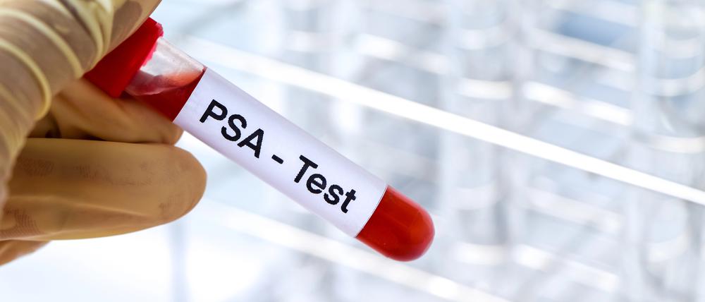 Der PSA-Test soll die Früherkennung von Prostatakrebs verbessern. (Symbolbild)