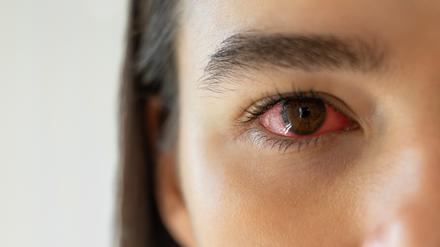Das Sicca-Syndrom betrifft häufig Frauen und zeigt sich unter anderem durch stark gerötete Augen. (Symbolbild)