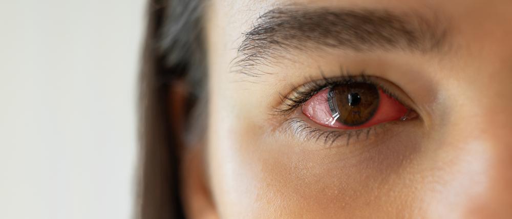 Das Sicca-Syndrom betrifft häufig Frauen und zeigt sich unter anderem durch stark gerötete Augen. (Symbolbild)