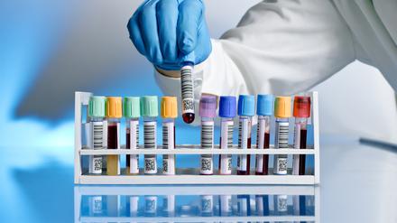 Das prostataspezifische Antigen (PSA) wird mittels Bluttest ermittelt