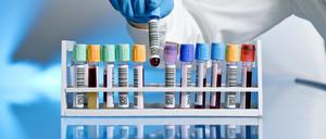 Das prostataspezifische Antigen (PSA) wird mittels Bluttest ermittelt