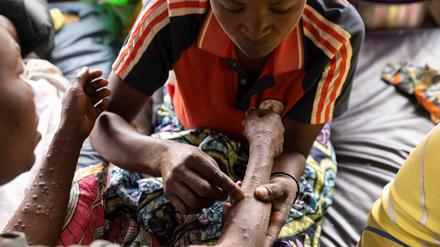 Ein Mann in der Republik Kongo behandelt den Arm einer Mpox-Patientin.