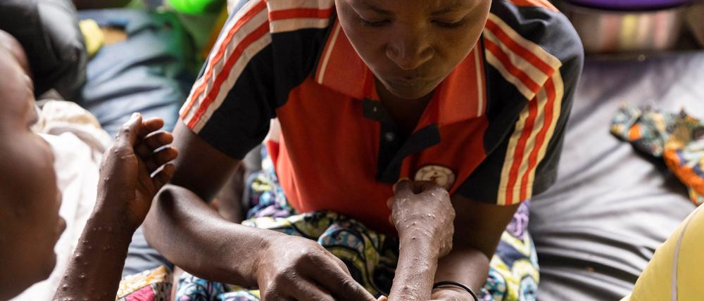 Ein Mann in der Republik Kongo behandelt den Arm einer Mpox-Patientin.