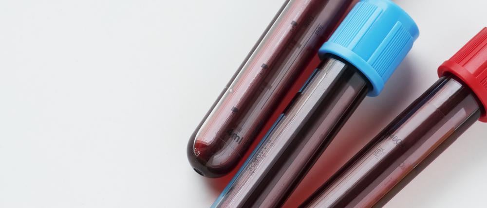 Röhrchen mit Blut für einen Bluttest (Symbolbild)