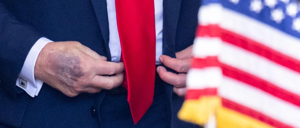 Bei einem Termin im Weißen Haus ist ein Bluterguss auf der rechten Hand des US-Präsidenten Donald Trump zu erkennen.