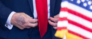 Bei einem Termin im Weißen Haus ist ein Bluterguss auf der rechten Hand des US-Präsidenten Donald Trump zu erkennen. 
