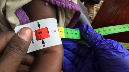 Ein Arzt misst im Sudan den Armumfang eines schwer unterernährten Babys (Archivbild)
