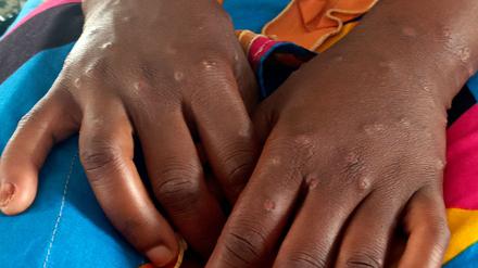 Mpox ist vor allem für kleine Kinder und immungeschwächte Menschen gefährlich (Archivbild)