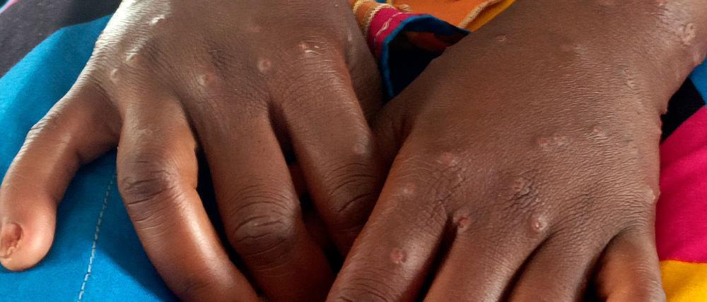 Mpox ist vor allem für kleine Kinder und immungeschwächte Menschen gefährlich (Archivbild)