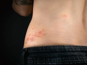 Eine Frau leidet unter dem für Gürtelrose typischen Hautausschlag an der Hüfte.