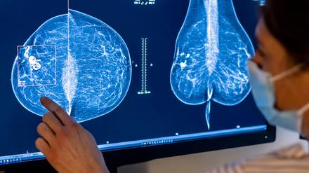 Für Frauen gibt es eine spezielle Untersuchung, um Krebs früh zu entdecken: die Mammografie.
