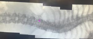 Danes Wirbelsäule ist vor allem im Brustbereich stark gekrümmt, wie dieses Röntgenbild zeigt.