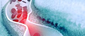 Entstehen sogenannten Plaques in den Gefäßen, kann es gefährlich werden,