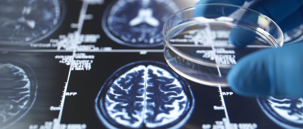 Allein in Deutschland lebten bis Ende des Jahres 2023 rund 1,8 Millionen Menschen mit Demenz. Die häufigste Demenzursache ist die Alzheimer-Erkrankung.