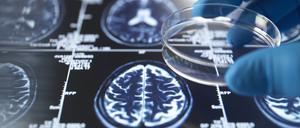 Allein in Deutschland lebten bis Ende des Jahres 2023 rund 1,8 Millionen Menschen mit Demenz. Die häufigste Demenzursache ist die Alzheimer-Erkrankung.