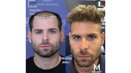 Vorher-Nachher Ergebnis nach 7 Monaten // Weiterer Text über ots und www.presseportal.de/nr/181508 / Die Verwendung dieses Bildes für redaktionelle Zwecke ist unter Beachtung aller mitgeteilten Nutzungsbedingungen zulässig und dann auch honorarfrei. Veröffentlichung ausschließlich mit Bildrechte-Hinweis.