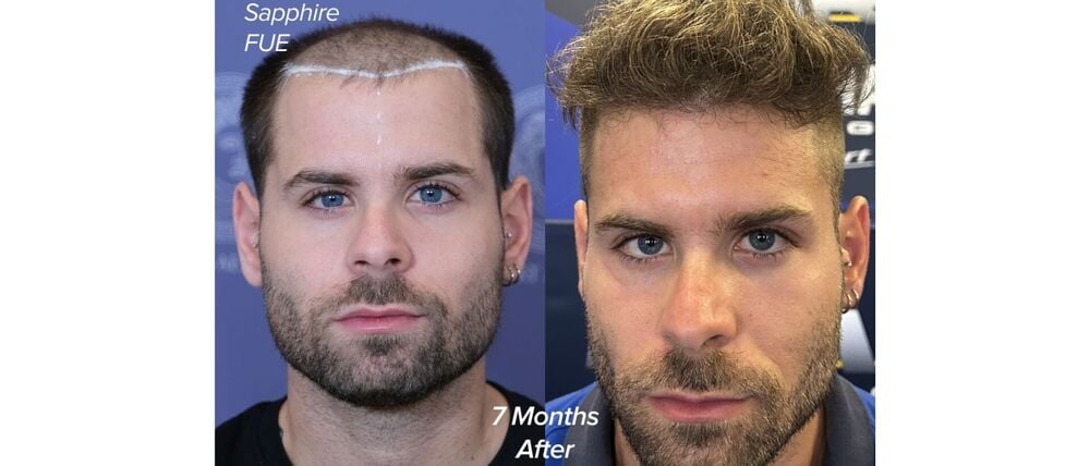 Vorher-Nachher Ergebnis nach 7 Monaten // Weiterer Text über ots und www.presseportal.de/nr/181508 / Die Verwendung dieses Bildes für redaktionelle Zwecke ist unter Beachtung aller mitgeteilten Nutzungsbedingungen zulässig und dann auch honorarfrei. Veröffentlichung ausschließlich mit Bildrechte-Hinweis.