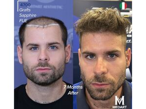 Vorher-Nachher Ergebnis nach 7 Monaten // Weiterer Text über ots und www.presseportal.de/nr/181508 / Die Verwendung dieses Bildes für redaktionelle Zwecke ist unter Beachtung aller mitgeteilten Nutzungsbedingungen zulässig und dann auch honorarfrei. Veröffentlichung ausschließlich mit Bildrechte-Hinweis.