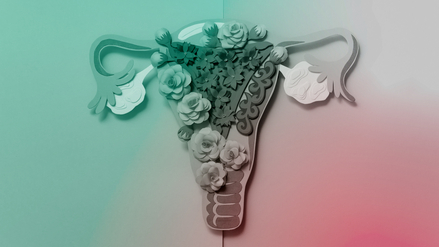 Darstellung eines von Endometriose betroffenen Uterus