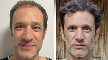 Vorher-Nachher Vergleich einer erfolgreichen FUE Haartransplantation in der Türkei, Istanbul. Das Bild zeigt die Ausgangslage mit Haarausfall und das dichte Endergebnis nach 12 Monaten. // Weiterer Text über ots und www.presseportal.de/nr/181698 / Die Verwendung dieses Bildes für redaktionelle Zwecke ist unter Beachtung aller mitgeteilten Nutzungsbedingungen zulässig und dann auch honorarfrei. Veröffentlichung ausschließlich mit Bildrechte-Hinweis.