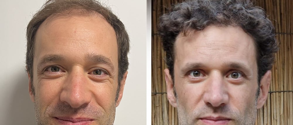 Vorher-Nachher Vergleich einer erfolgreichen FUE Haartransplantation in der Türkei, Istanbul. Das Bild zeigt die Ausgangslage mit Haarausfall und das dichte Endergebnis nach 12 Monaten. // Weiterer Text über ots und www.presseportal.de/nr/181698 / Die Verwendung dieses Bildes für redaktionelle Zwecke ist unter Beachtung aller mitgeteilten Nutzungsbedingungen zulässig und dann auch honorarfrei. Veröffentlichung ausschließlich mit Bildrechte-Hinweis.