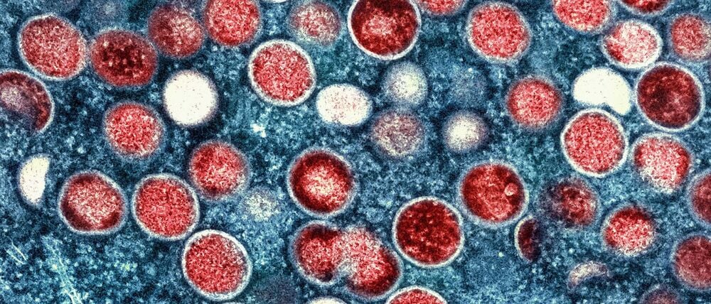 In Berlin zirkulieren Mpox-Viren, so dass Infektionen auch hier möglich sind. (Archivfoto)