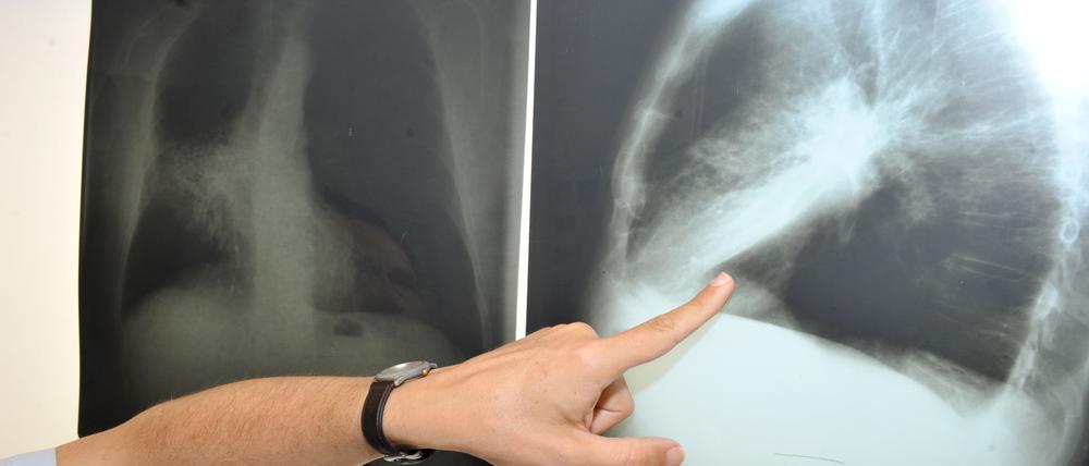 Heilbar ist fortgeschrittener, metastasierender Lungenkrebs in der Regel nicht. Aber es gibt jetzt ein vielversprechendes Mittel, das den Patienten wertvolle Lebenszeit verschafft.