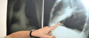 Heilbar ist fortgeschrittener, metastasierender Lungenkrebs in der Regel nicht. Aber es gibt jetzt ein vielversprechendes Mittel, das den Patienten wertvolle Lebenszeit verschafft.