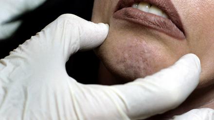 Botox