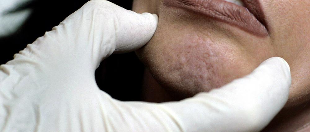 Botox