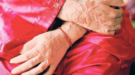 Lebenslang gezeichnet. Die ätzende Substanz brennt sich für immer in die Haut ein. Die meisten Opfer von Säureattacken können nie wieder in ihr früheres Leben zurück, da sie gehänselt und verstoßen werden. 