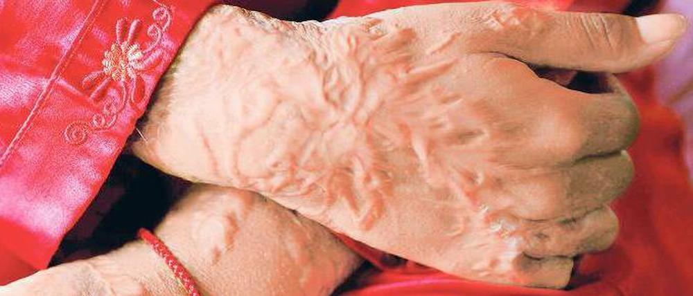 Lebenslang gezeichnet. Die ätzende Substanz brennt sich für immer in die Haut ein. Die meisten Opfer von Säureattacken können nie wieder in ihr früheres Leben zurück, da sie gehänselt und verstoßen werden. 