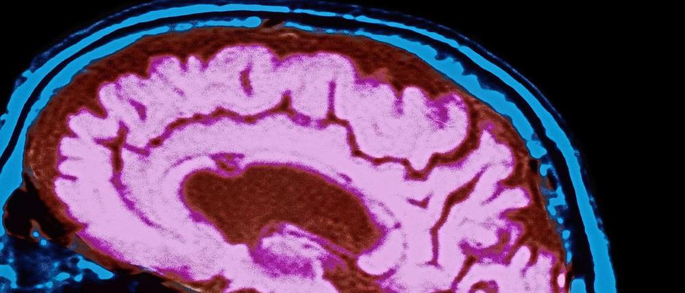 In Deutschland gibt es derzeit 1,2 Millionen Patienten. 
