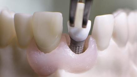 Ein Zahnimplantat wird in ein Unterkiefermodell eingesetzt