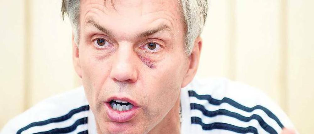 Beim Zähneputzen entdeckt. Gordon Herbert erklärt, er wisse nicht, woher sein blaues Auge kommt.