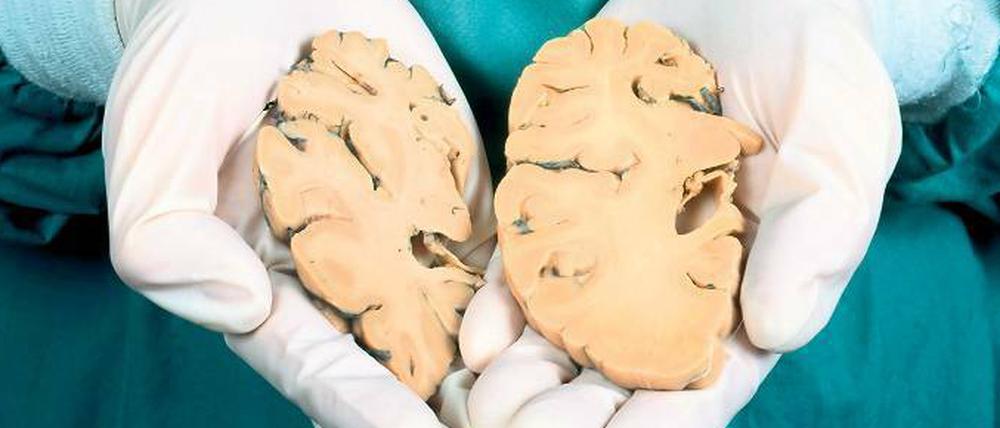 Geschrumpft. Ein Pathologe zeigt im Vergleich das Hirnpräparat eines Alzheimer-Patienten (links) mit deutlichem Substanzverlust und das eines Gesunden. Foto: Focus/SPL
