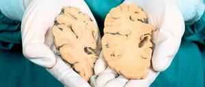 Geschrumpft. Ein Pathologe zeigt im Vergleich das Hirnpräparat eines Alzheimer-Patienten (links) mit deutlichem Substanzverlust und das eines Gesunden. Foto: Focus/SPL