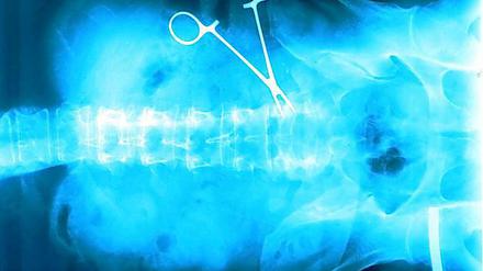 Schere vergessen: Am häufigsten sahen sich Orthopäden und Chirurgen mit dem Verdacht konfrontiert, bei der Behandlung etwas falsch gemacht zu haben.