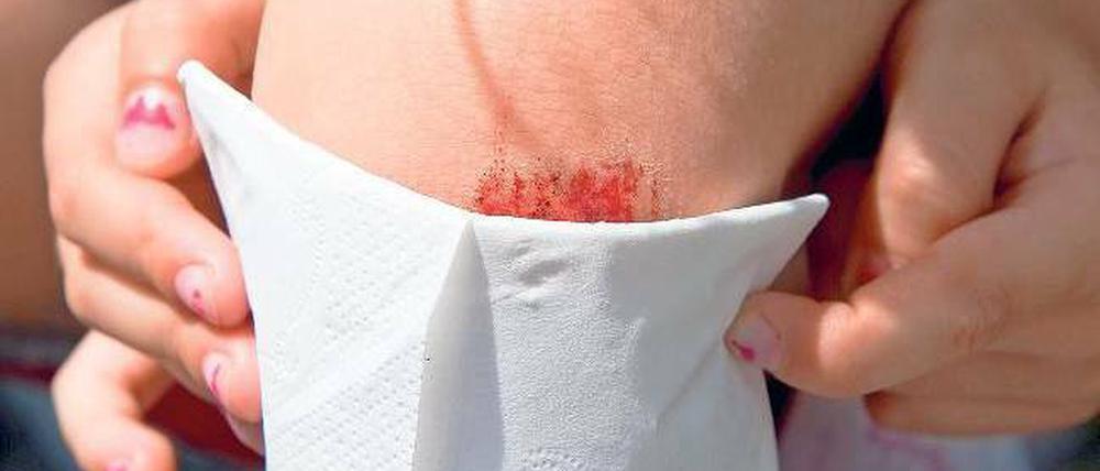 Alltäglich. Ein aufgeschürftes Knie heilt normalerweise von allein. Dabei wandern neue Zellen einige Millimeter wie auf einem Fließband unter der Haut zur Wunde. Foto: imago